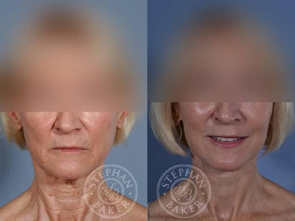 Face and Neck Lift Patient by Dr. Baker