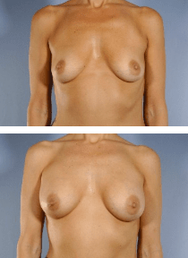 Dr. Baker Breast Aug case PM