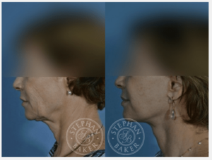 Facelift and Neck Lift Before & After Photos