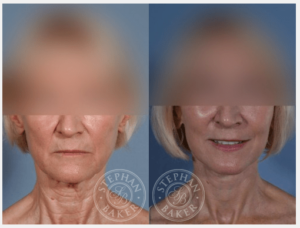 Facelift Before and After Photos