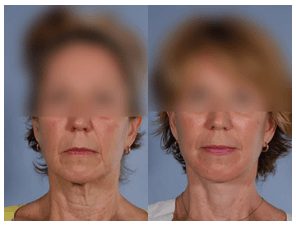 Facelift by Dr. Baker