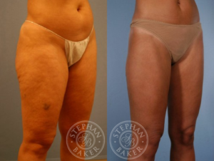 Liposuction Before and After Photos