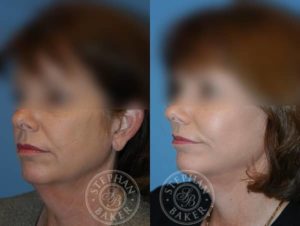 Dr. Baker facelift patient