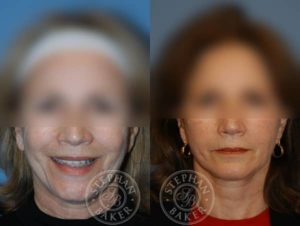 Face and Neck Lift Patient by Dr. Baker