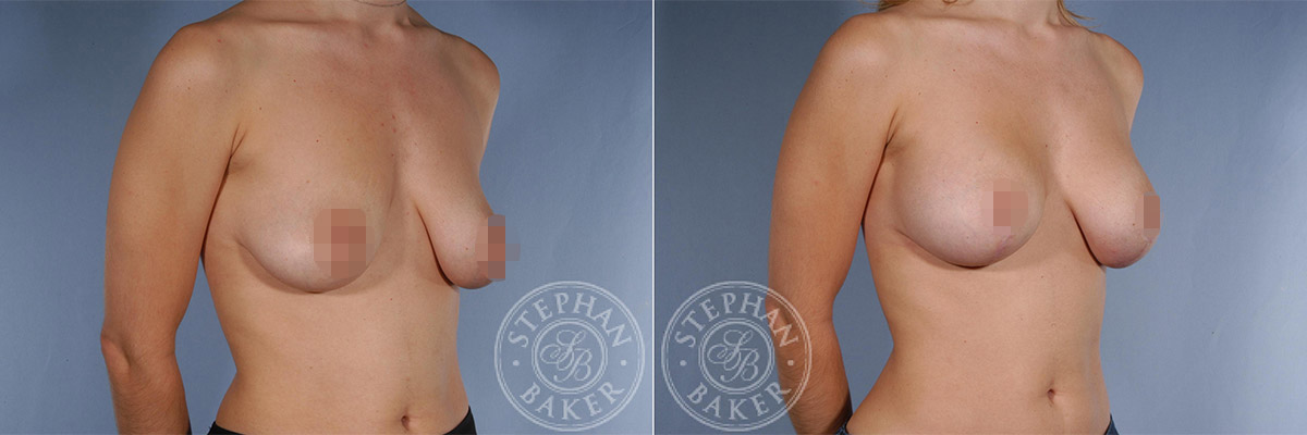 Breast Lift Before-and-After Photo | Miami, FL | Dr. Baker