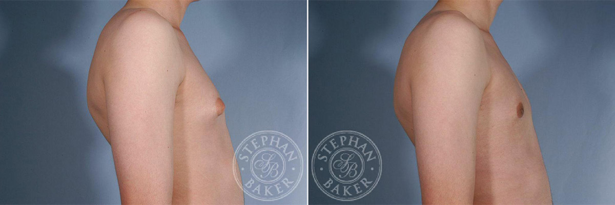 Male Breast Reduction Before-and-After Photos | Miami, FL | Dr. Baker