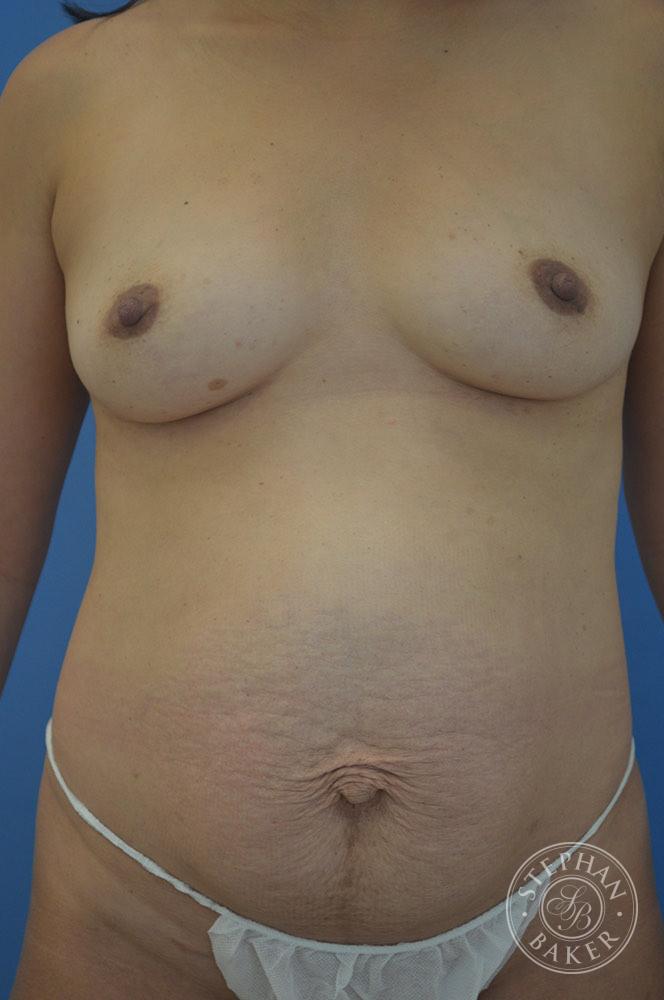 Mommy Makeover Before & After Image