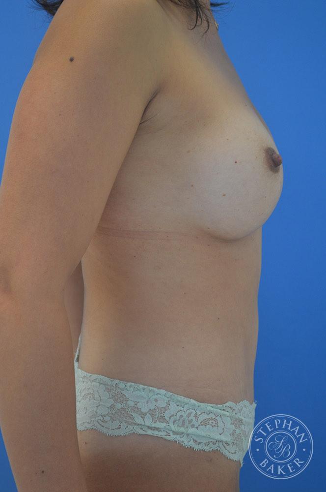 Mommy Makeover Before & After Image