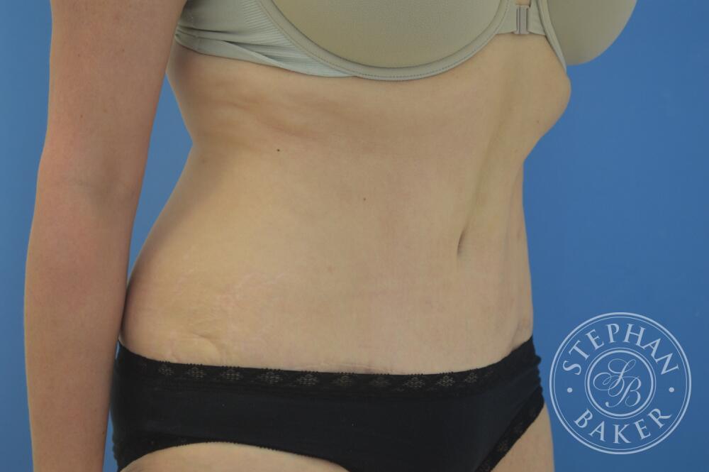 Tummy Tuck Before & After Image