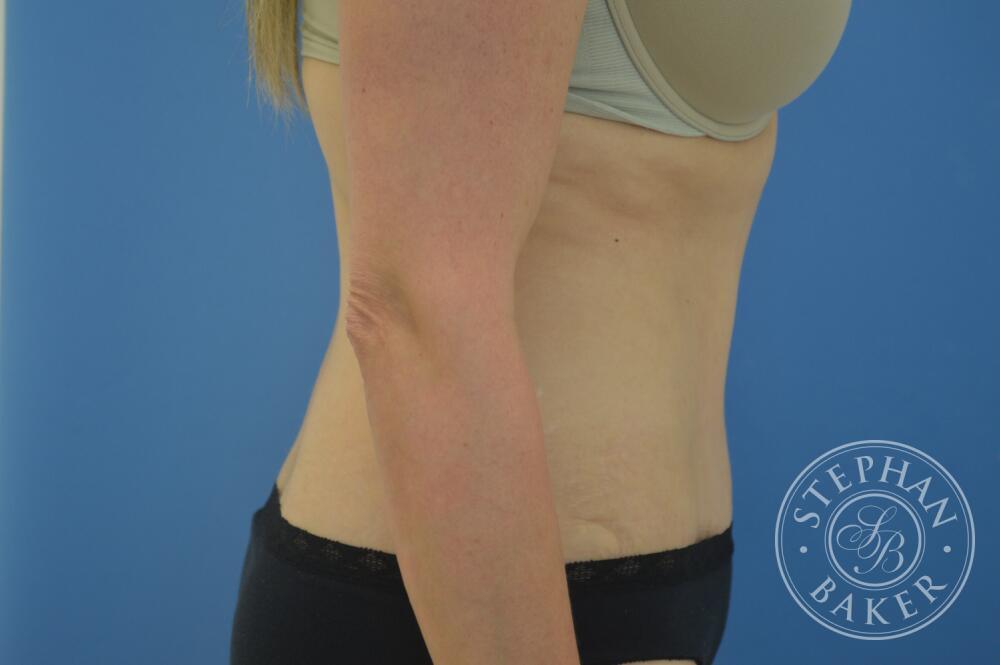Tummy Tuck Before & After Image
