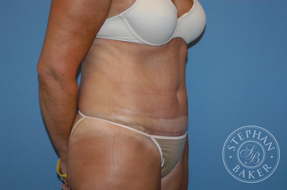 Tummy Tuck Before & After Image