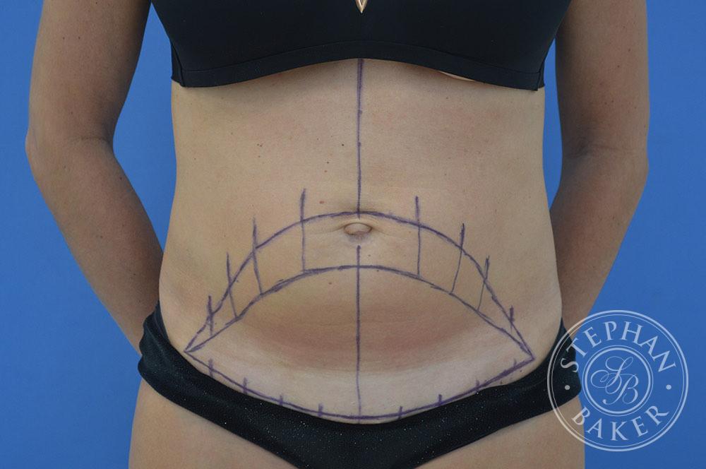 Tummy Tuck Before & After Image