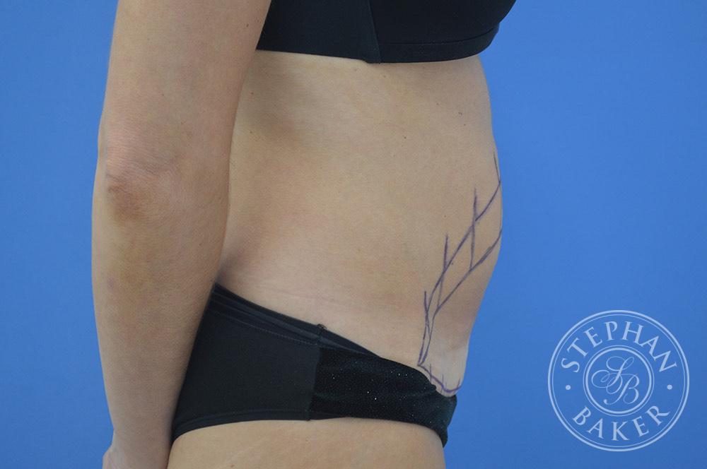Tummy Tuck Before & After Image