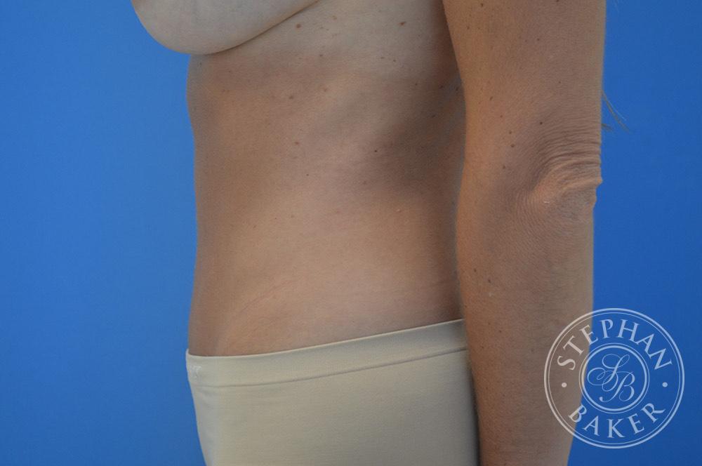 Tummy Tuck Before & After Image