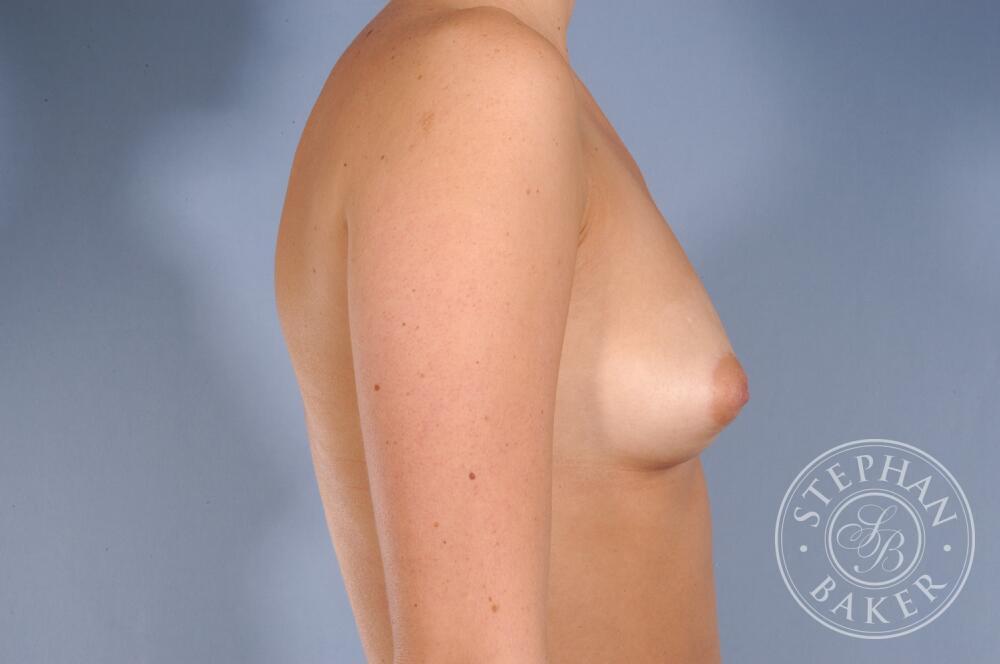 Breast Augmentation Before & After Image
