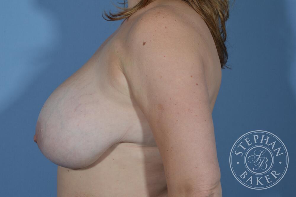 Breast Reduction Before & After Image