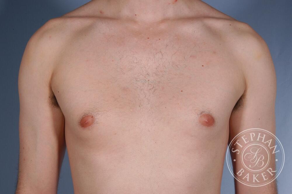 Gynecomastia Before & After Image