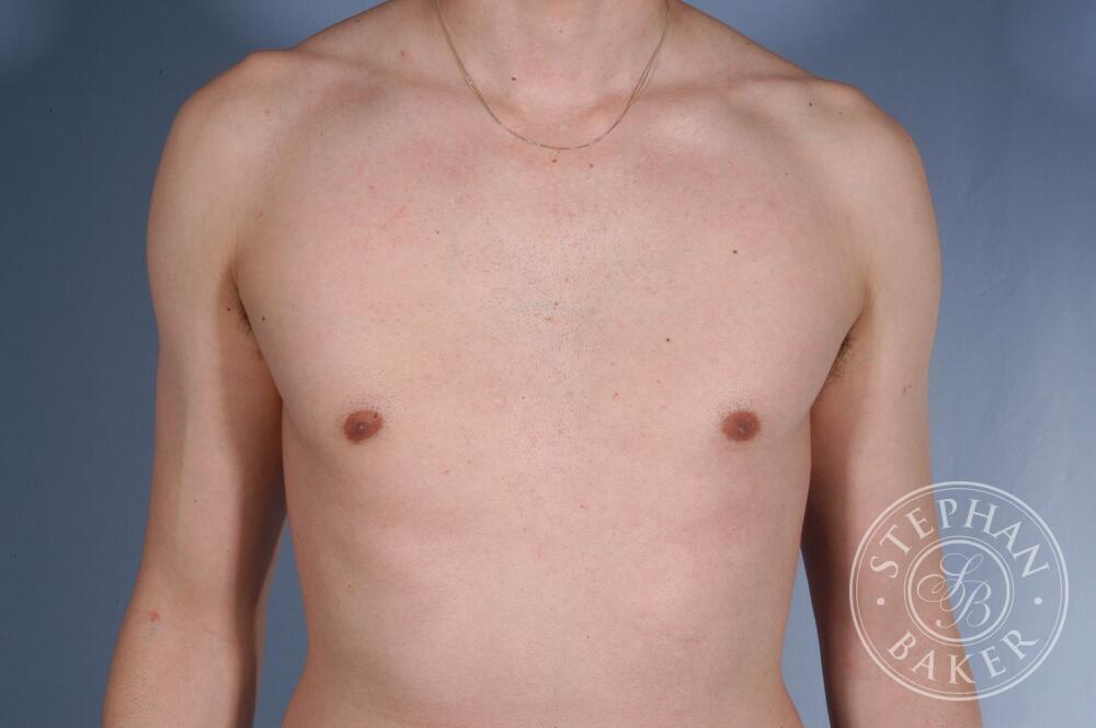 Gynecomastia Before & After Image