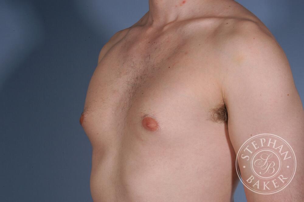 Gynecomastia Before & After Image