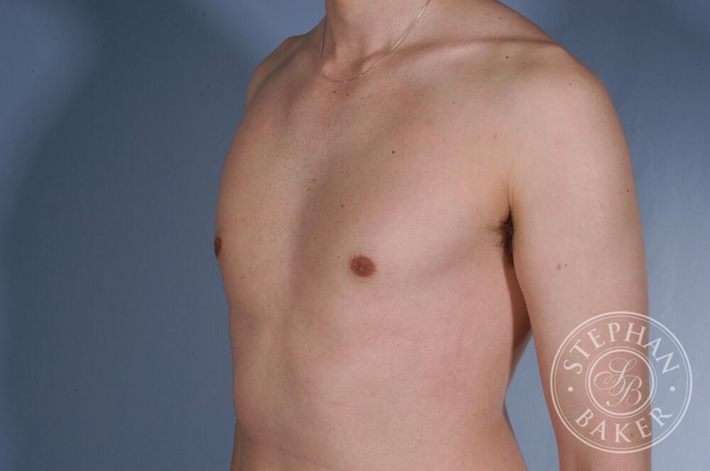 Gynecomastia Before & After Image