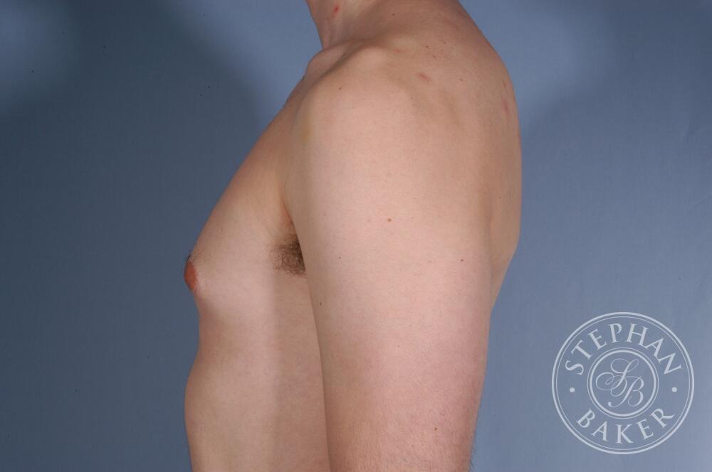 Gynecomastia Before & After Image