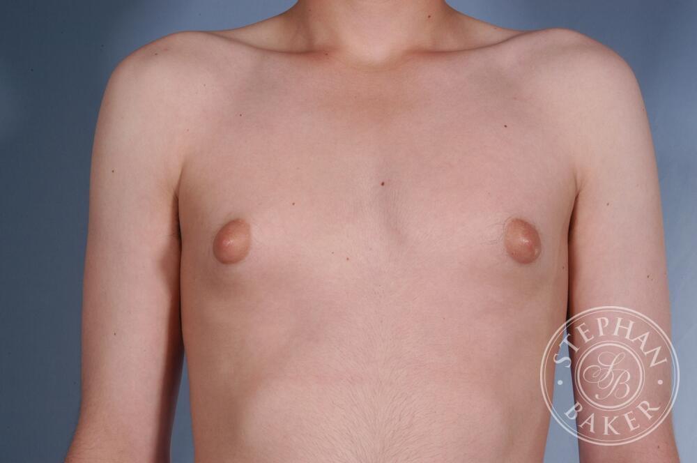 Gynecomastia Before & After Image