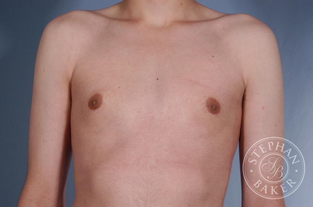 Gynecomastia Before & After Image