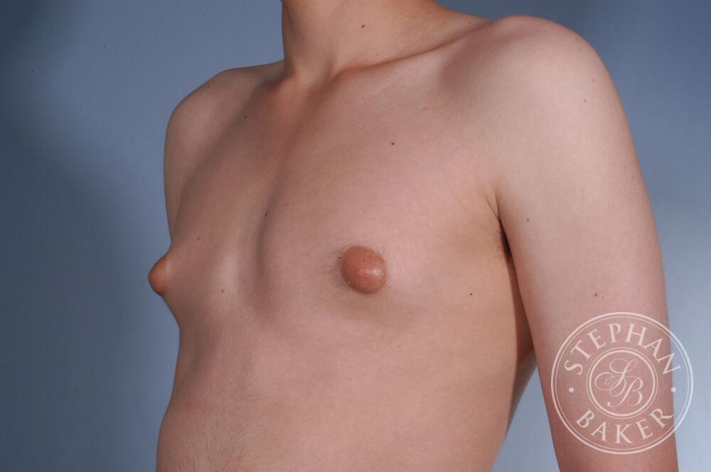 Gynecomastia Before & After Image