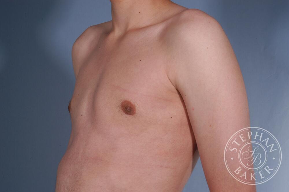 Gynecomastia Before & After Image