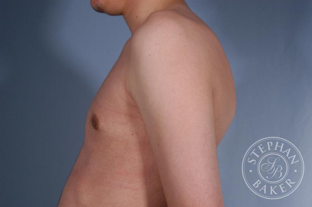 Gynecomastia Before & After Image