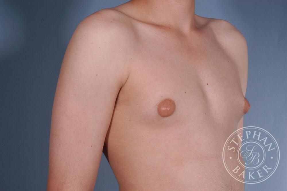 Gynecomastia Before & After Image