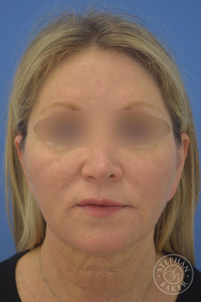 Face & Neck Lift Before & After Image