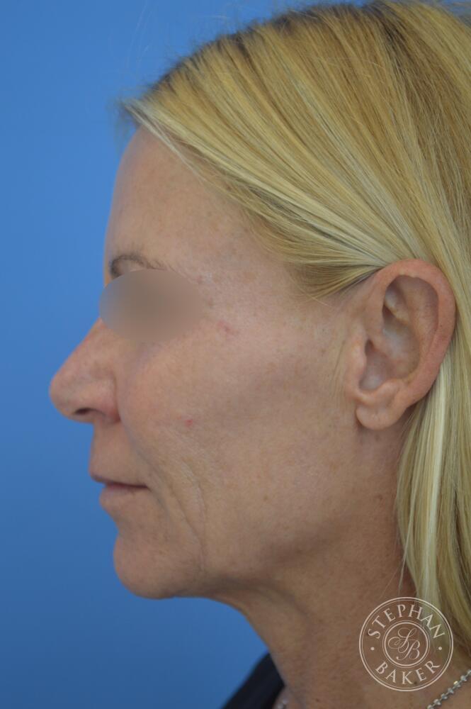 Face & Neck Lift Before & After Image