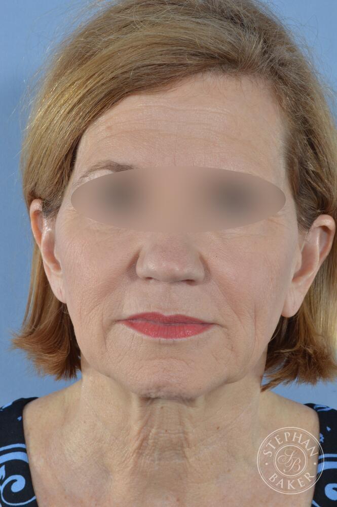 Face & Neck Lift Before & After Image