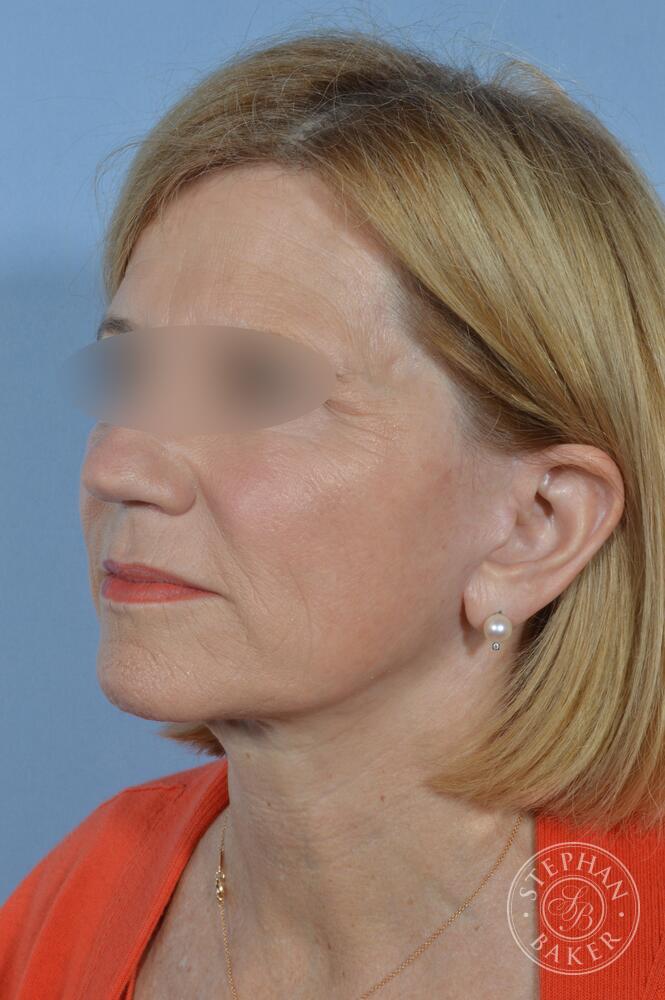 Face & Neck Lift Before & After Image