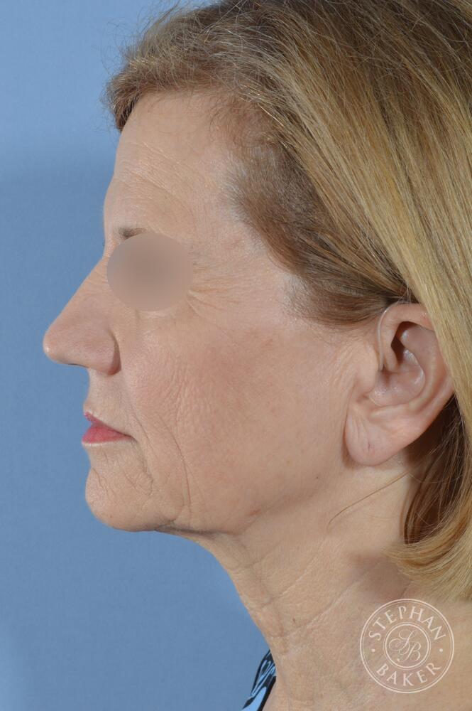 Face & Neck Lift Before & After Image