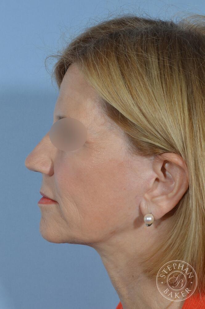 Face & Neck Lift Before & After Image