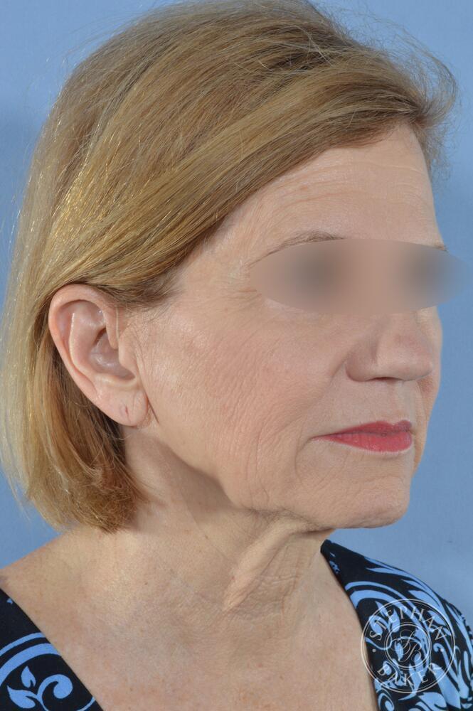 Face & Neck Lift Before & After Image