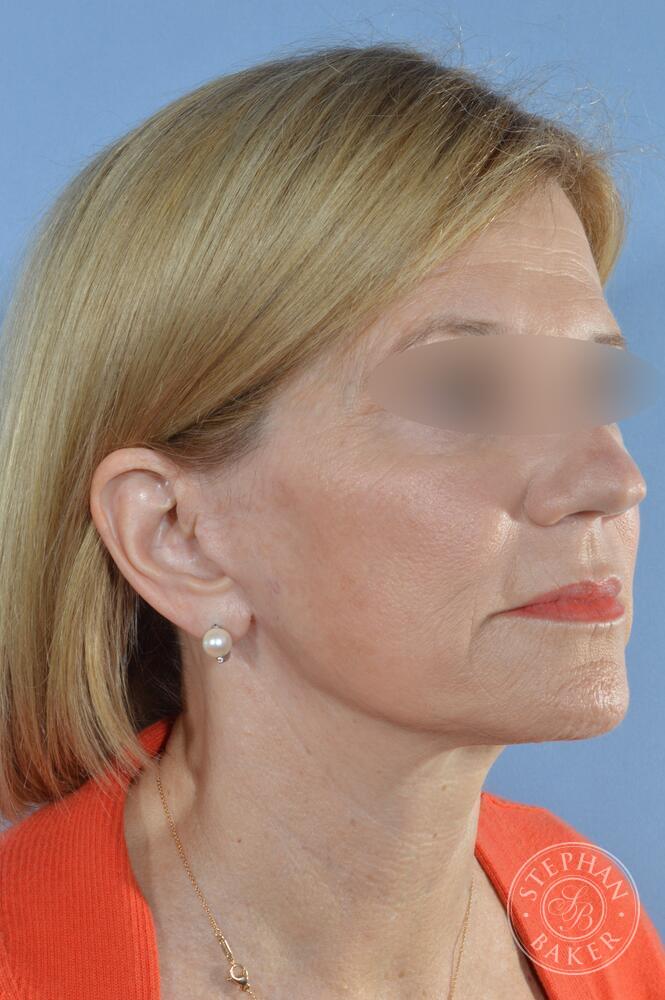 Face & Neck Lift Before & After Image