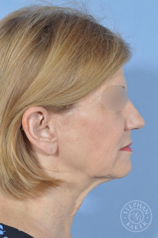 Face & Neck Lift Before & After Image