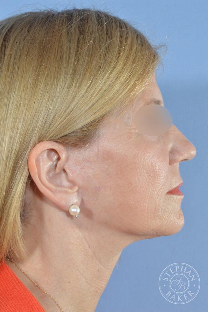 Face & Neck Lift Before & After Image