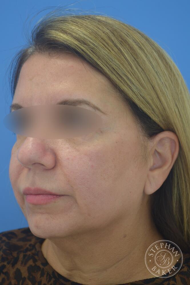 Face & Neck Lift Before & After Image