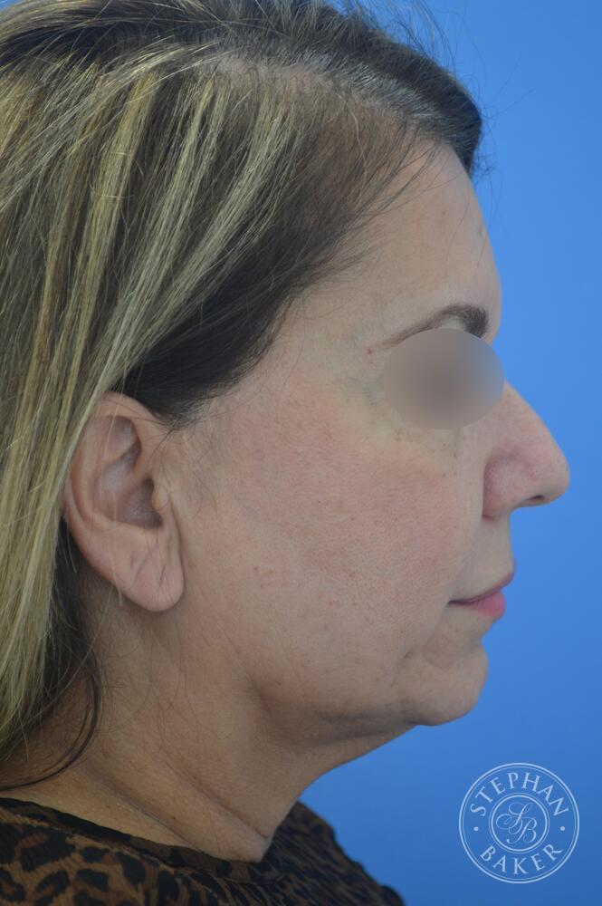 Face & Neck Lift Before & After Image