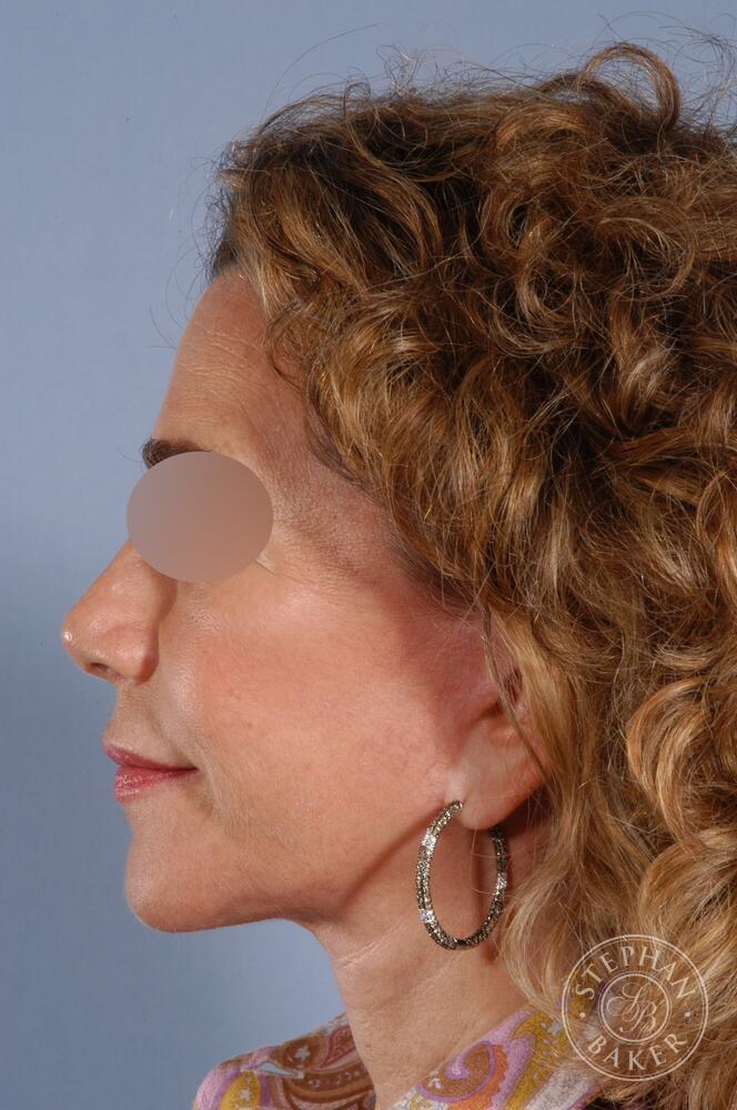 Face & Neck Lift Before & After Image