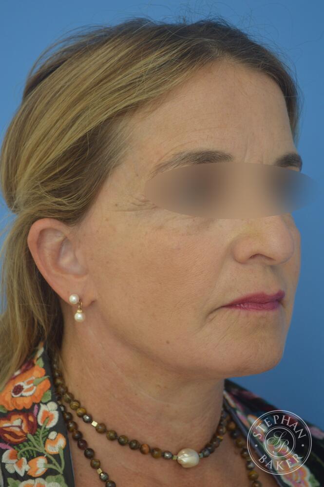 Face & Neck Lift Before & After Image