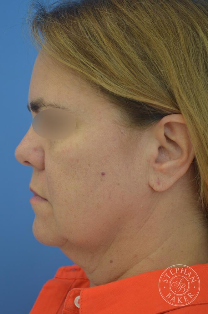 Face & Neck Lift Before & After Image