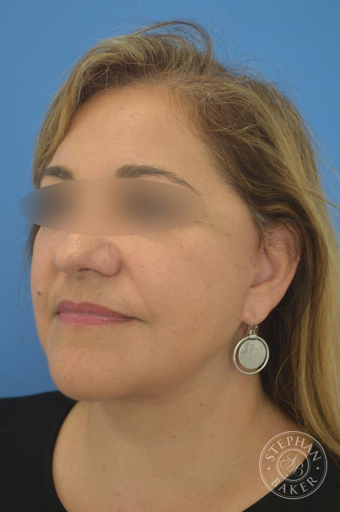 Face & Neck Lift Before & After Image