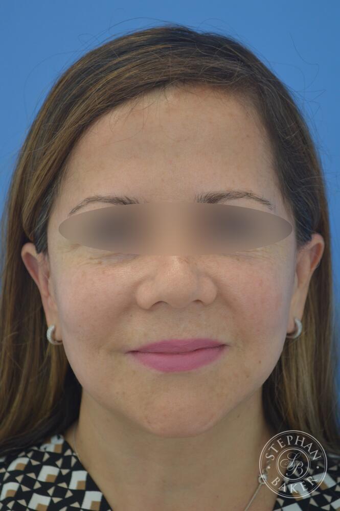 Face & Neck Lift Before & After Image