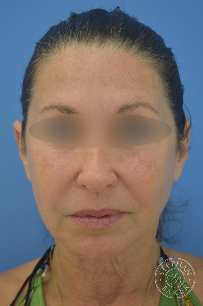 Face & Neck Lift Before & After Image