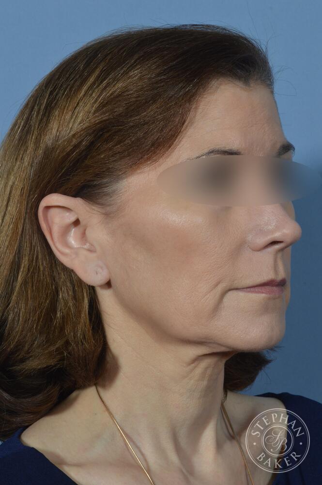 Face & Neck Lift Before & After Image